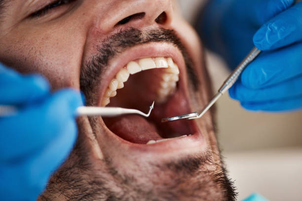 Best Emergency Wisdom Teeth Removal in Williamsburg, OH